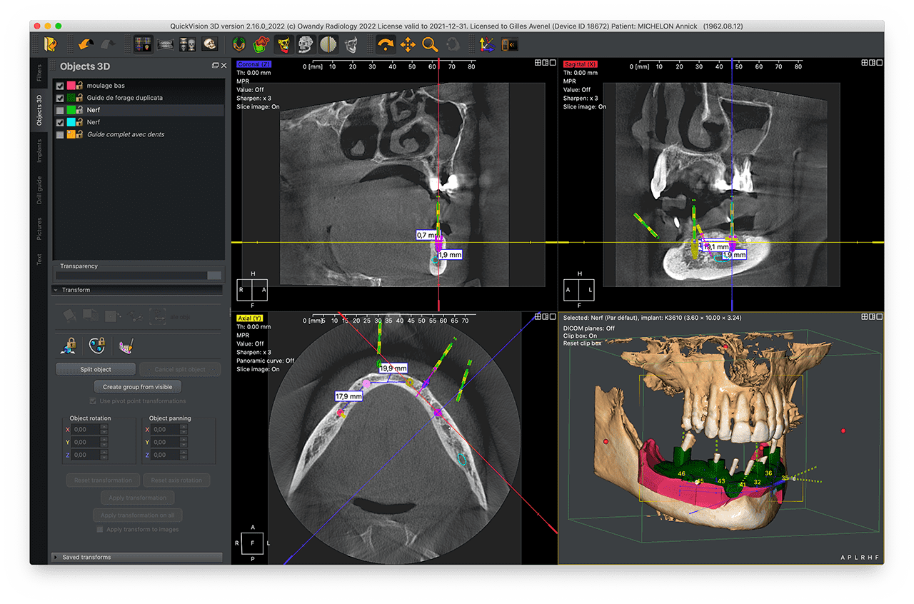 QuickVision 3D implant planning