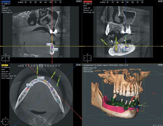 AutoMAR metal artifact reduction
